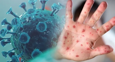 Oncosem’den Maymun Çiçeği Virüsüne Karşı Hızlı Adım!